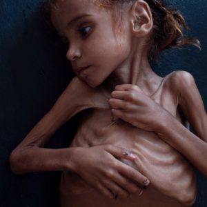 New York Times Photo of a Starving Child in Yemen